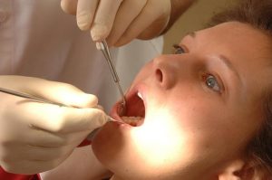 Пробив в стоматологията: Създадоха гел, който възстановява емайла на зъбите