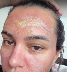 Мнима козметичка обезобрази майка, заплашва я след химически пилинг