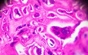 Случаи на проказа в Хърватия и Румъния: Пациенти са чуждестранни работници