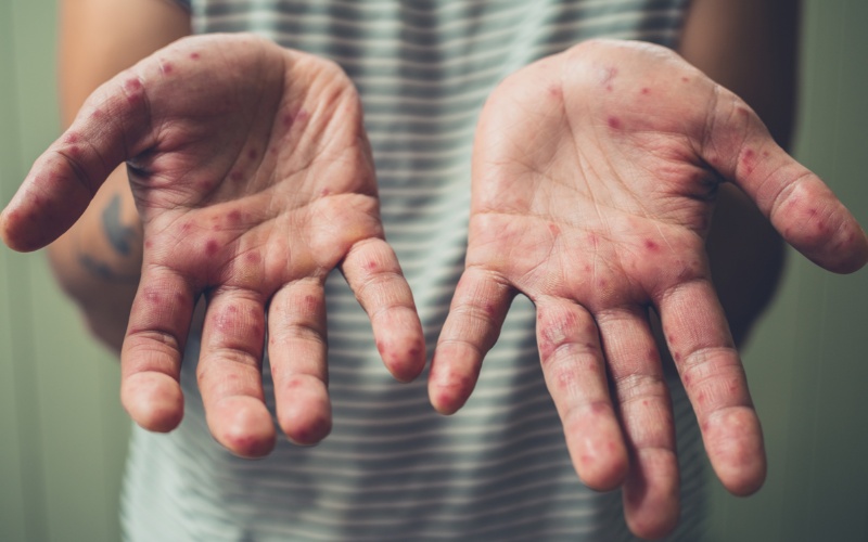 Регистрирани са 99 случая на морбили у нас след нови пет заболели деца