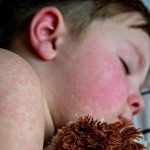 364 случая на морбили в страната: 300 от заболелите са деца
