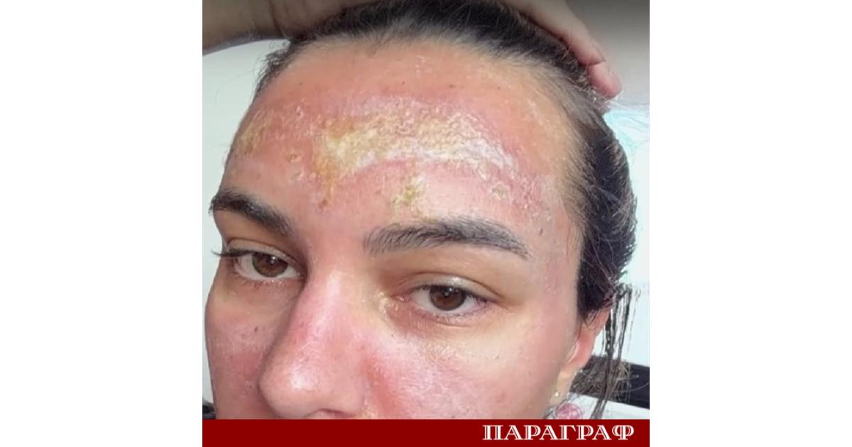 Лиана Георгиева млада майка преживява изгаряне втора степен след процедура