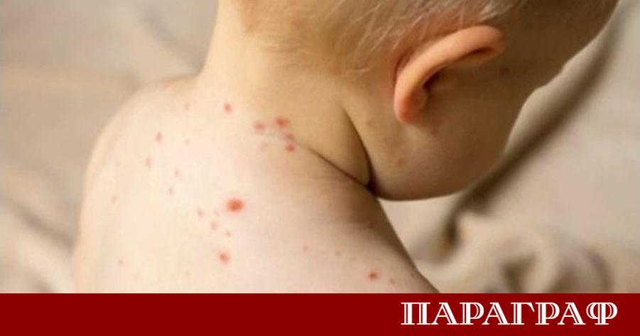 Общо за страната случаите на морбили от началото на годината
