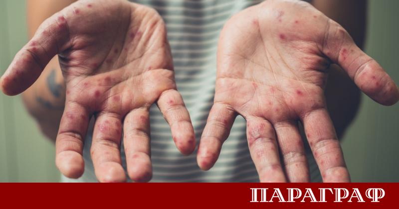 Министерството на здравеопазването съобщи за пет нови случая на морбили