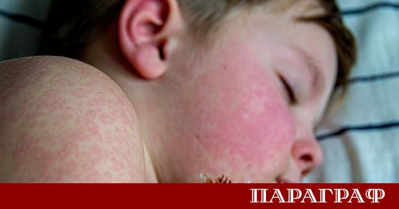 Министерството на здравеопазването съобщи за 364 случая на морбили в