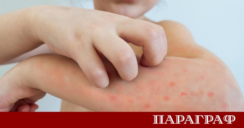 Ваксинирането срещу варицела става задължително в България от юли тази